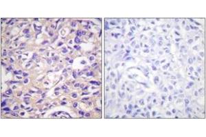 Immunohistochemistry analysis of paraffin-embedded human breast carcinoma, using TK (Phospho-Ser13) Antibody. (TK (AA 1-50), (pSer13) anticorps)