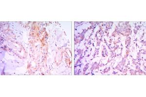Immunohistochemical analysis of paraffin-embedded thyroid gland tissues (left) and human breast carcinoma (right) using RICTOR mouse mAb with DAB staining.