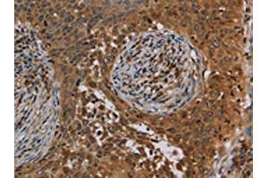 The image on the left is immunohistochemistry of paraffin-embedded Human cervical cancer tissue using ABIN7191746(OSM Antibody) at dilution 1/40, on the right is treated with synthetic peptide. (Oncostatin M anticorps)