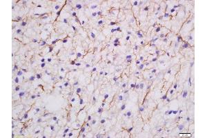 Formalin-fixed and paraffin embedded human glioma labeled with Rabbit Anti-MDGA2 Polyclonal Antibody, Unconjugated  at 1:200 followed by conjugation to the secondary antibody and DAB staining (MDGA2 anticorps  (AA 751-850))