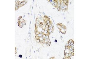 Immunohistochemistry of paraffin-embedded human gastric cancer using IER3 antibody (ABIN6134174, ABIN6142158, ABIN6142159 and ABIN6224665) at dilution of 1:100 (40x lens).
