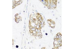 Immunohistochemistry of paraffin-embedded human gastric cancer using IER3 antibody (ABIN6134174, ABIN6142158, ABIN6142159 and ABIN6224665) at dilution of 1:100 (40x lens). (IER3 anticorps  (C-Term))