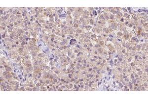 ABIN6273349 at 1/100 staining Human thyroid cancer tissue by IHC-P. (WSB1 anticorps  (Internal Region))