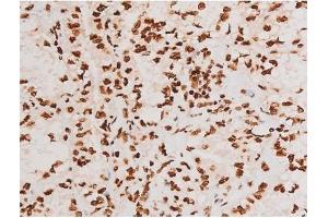 ABIN6267604 at 1/200 staining Human lung cancer tissue sections by IHC-P.