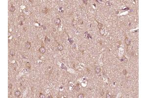 Paraformaldehyde-fixed, paraffin embedded human glioma, Antigen retrieval by boiling in sodium citrate buffer (pH6) for 15min, Block endogenous peroxidase by 3% hydrogen peroxide for 30 minutes,  Blocking buffer (normal goat serum) at 37°C for 20min, Antibody incubation with PTPN6(Tyr536) Polyclonal Antibody (bs-5577R) at 1:400 overnight at 4°C, followed by a conjugated secondary and DAB staining.