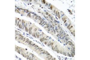 Immunohistochemistry of paraffin-embedded human colon carcinoma using TIA1 antibody (ABIN6293426) at dilution of 1:100 (40x lens). (TIA1 anticorps)