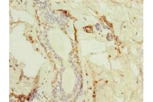 Immunohistochemistry of paraffin-embedded human breast cancer using ABIN7172975 at dilution of 1:100 (TMED2 anticorps  (AA 26-111))