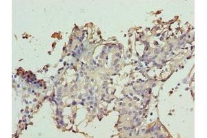 Immunohistochemistry of paraffin-embedded human breast cancer using ABIN7171951 at dilution of 1:100