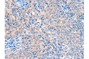 The image on the left is immunohistochemistry of paraffin-embedded Human cervical cancer tissue using ABIN7128170(ACOX1 Antibody) at dilution 1/20, on the right is treated with fusion protein. (ACOX1 anticorps)