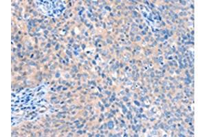 The image on the left is immunohistochemistry of paraffin-embedded Human cervical cancer tissue using ABIN7128170(ACOX1 Antibody) at dilution 1/20, on the right is treated with fusion protein. (ACOX1 anticorps)