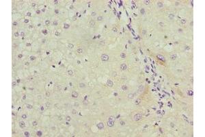 Immunohistochemistry of paraffin-embedded human liver cancer using ABIN7158038 at dilution of 1:100