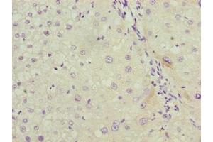 Immunohistochemistry of paraffin-embedded human liver cancer using ABIN7158038 at dilution of 1:100 (LRG1 anticorps  (AA 36-346))