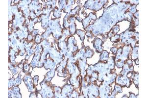 Formalin-fixed, paraffin-embedded human Angiosarcoma stained with CD31 Rabbit Recombinant Monoclonal Antibody (C31/2876R). (Recombinant CD31 anticorps)