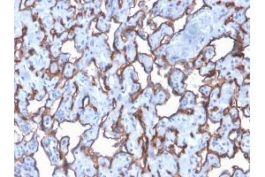 Formalin-fixed, paraffin-embedded human Angiosarcoma stained with CD31 Rabbit Recombinant Monoclonal Antibody (C31/2876R). (Recombinant CD31 anticorps)