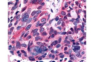 Anti-ESRRB / ERR Beta antibody IHC of human Lung, Small Cell Carcinoma.