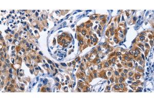 Immunohistochemistry of paraffin-embedded Human lung cancer tissue using MYH1 Polyclonal Antibody at dilution 1:40 (MYH1 anticorps)