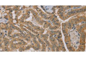 Immunohistochemistry of paraffin-embedded Human thyroid cancer using MVK Polyclonal Antibody at dilution of 1:40 (MVK anticorps)