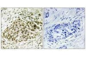 Immunohistochemistry analysis of paraffin-embedded human lung carcinoma tissue, using Lyl-1 antibody. (LYL1 anticorps)