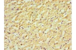 Immunohistochemistry of paraffin-embedded human liver cancer using ABIN7170658 at dilution of 1:100