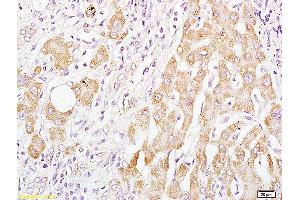Formalin-fixed and paraffin embedded human liver carcinoma labeled with Anti-BAAT Polyclonal Antibody, Unconjugated (ABIN708776) at 1:200 followed by conjugation to the secondary antibody and DAB staining. (BAAT anticorps  (AA 101-200))