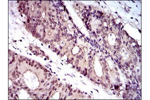 Immunohistochemical analysis of paraffin-embedded colon cancer tissues using WHSC2 mouse mAb with DAB staining.