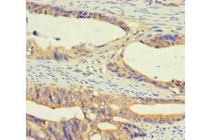 Immunohistochemistry of paraffin-embedded human colon cancer using ABIN7174635 at dilution of 1:100 (UGT2A3 anticorps  (AA 201-491))
