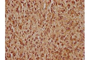 IHC image of ABIN7139815 diluted at 1:400 and staining in paraffin-embedded human glioma performed on a Leica BondTM system.
