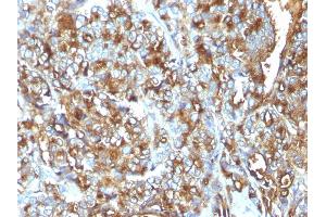 Formalin-fixed, paraffin-embedded human Breast Carcinoma stained with MUC-1 / EMA Mouse Monoclonal Antibody (MUC1/520).