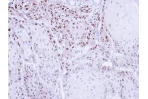 IHC-P Image Immunohistochemical analysis of paraffin-embedded Cal27 Xenograft , using CSE1L, antibody at 1:500 dilution. (Exportin 2 anticorps  (Center))