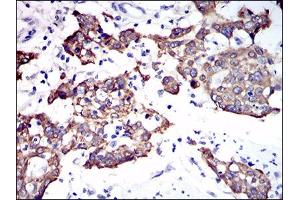 Immunohistochemical analysis of paraffin-embedded esophagus cancer tissues using CK5 mouse mAb with DAB staining. (Cytokeratin 5 anticorps  (AA 316-590))