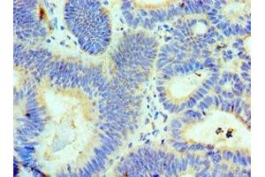 Immunohistochemistry of paraffin-embedded human colon cancer using ABIN7143718 at dilution of 1:100 (ALKBH8 anticorps  (AA 1-230))