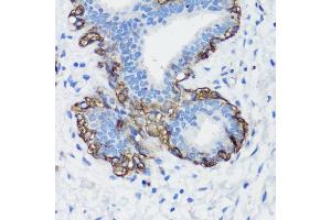 Immunohistochemistry of paraffin-embedded human breast cancer using Filamin A antibody (ABIN7267206) at dilution of 1:100 (40x lens). (Filamin A anticorps  (C-Term))
