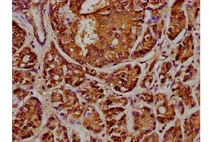 IHC image of ABIN7144072 diluted at 1:348 and staining in paraffin-embedded human pancreatic cancer performed on a Leica BondTM system. (ANAPC2 anticorps  (AA 1-230))