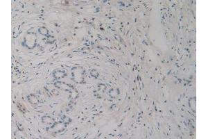 IHC-P analysis of Human Pancreas Cancer Tissue, with DAB staining. (H2AFY anticorps  (AA 109-369))
