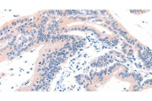Immunohistochemistry of paraffin-embedded Human colon cancer tissue using ITGA6 Polyclonal Antibody at dilution 1:50 (ITGA6 anticorps)