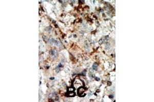Formalin-fixed and paraffin-embedded human cancer tissue reacted with the primary antibody, which was peroxidase-conjugated to the secondary antibody, followed by AEC staining.