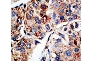 IHC analysis of FFPE human hepatocarcinoma tissue stained with the KMT4 antibody