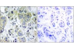 Immunohistochemistry analysis of paraffin-embedded human breast carcinoma tissue, using p70 S6 Kinase (Ab-411) Antibody. (RPS6KB1 anticorps  (AA 401-450))