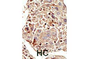 Formalin-fixed and paraffin-embedded human hepatocellular carcinoma tissue reacted with ACVR1 polyclonal antibody  , which was peroxidase-conjugated to the secondary antibody, followed by DAB staining. (ACVR1 anticorps  (Internal Region))