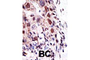 Formalin-fixed and paraffin-embedded human cancer tissue reacted with UBE2S polyclonal antibody  , which was peroxidase-conjugated to the secondary antibody, followed by AEC staining. (UBE2S anticorps  (N-Term))