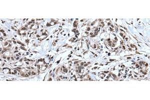 Immunohistochemistry of paraffin-embedded Human gastric cancer tissue using TIA1 Polyclonal Antibody at dilution of 1:30(x200) (TIA1 anticorps)