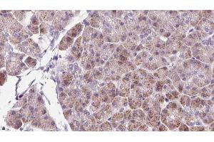 ABIN6273232 at 1/100 staining Human pancreas cancer tissue by IHC-P. (DBN1 anticorps  (Internal Region))