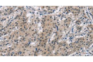 Immunohistochemistry of paraffin-embedded Human gastric cancer using SMAD9 Polyclonal Antibody at dilution of 1:30 (SMAD9 anticorps)