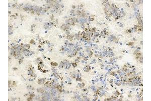 ABIN6256537 and ABIN6267228 at 1/100 staining human melanoma by IHC-P. (Aurora A anticorps  (pThr288))