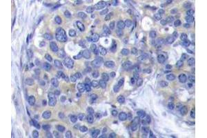 Immunohistochemistry analyzes of ZAP-70 antibody in paraffin-embedded human breast carcinoma tissue. (ZAP70 anticorps)