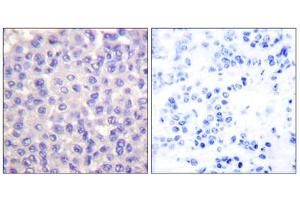 Immunohistochemical analysis of paraffin-embedded human breast carcinoma tissue using TGF beta 3 antibody (ABIN5976517). (TGFB3 anticorps  (Internal Region))