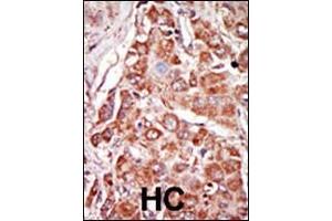 Formalin-fixed and paraffin-embedded human cancer tissue reacted with the primary antibody, which was peroxidase-conjugated to the secondary antibody, followed by DAB staining.