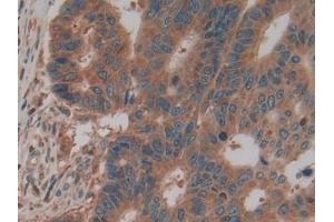 Detection of PKM2 in Human Colorectal cancer Tissue using Polyclonal Antibody to Pyruvate kinase isozymes M2 (PKM2)