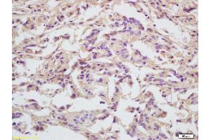 Formalin-fixed and paraffin embedded human gastric carcinoma labeled with Anti-MCM5 Polyclonal Antibody, Unconjugated (ABIN749648) at 1:200 followed by conjugation to the secondary antibody and DAB staining (MCM5 anticorps  (AA 651-734))