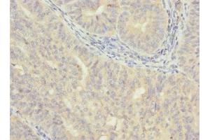 Immunohistochemistry of paraffin-embedded human endometrial cancer using ABIN7175638 at dilution of 1:100